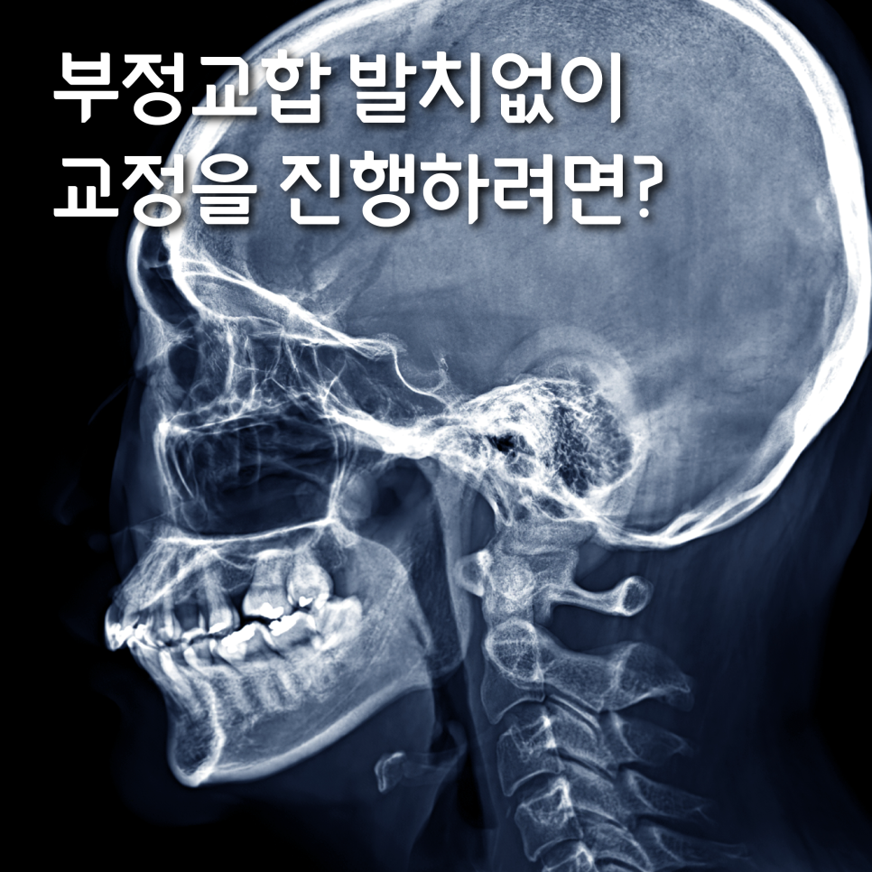 수유역부정교합치과 비발치로 교정을 진행하는 과정 관련 이미지 1
