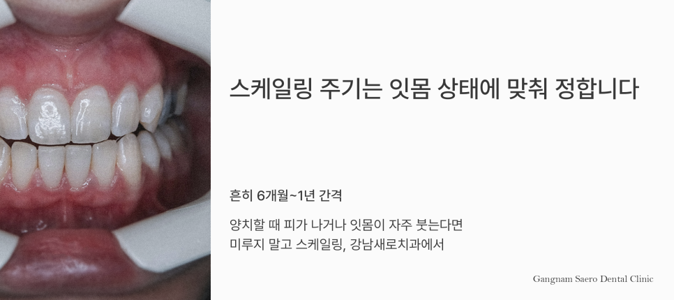 스케일링 후 이가 시리고 벌어졌다? 스케일링부작용 오해와 진실 관련 이미지 7