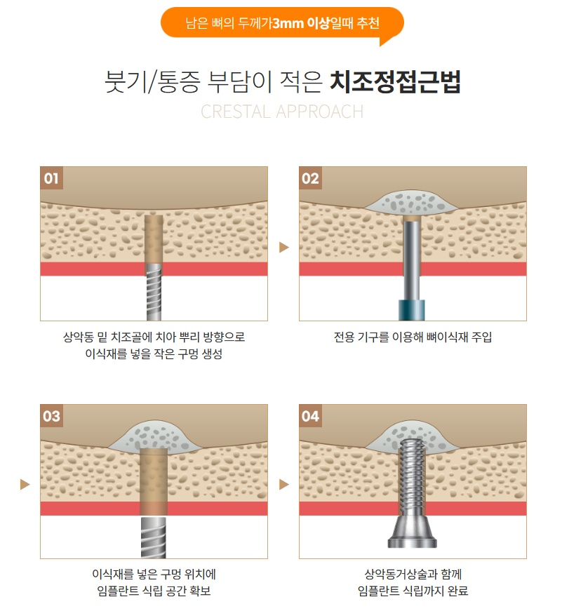 윗니 임플란트 안정성 높이는 강남새로치과 핵심 술식 （상악동거상술） 관련 이미지 3