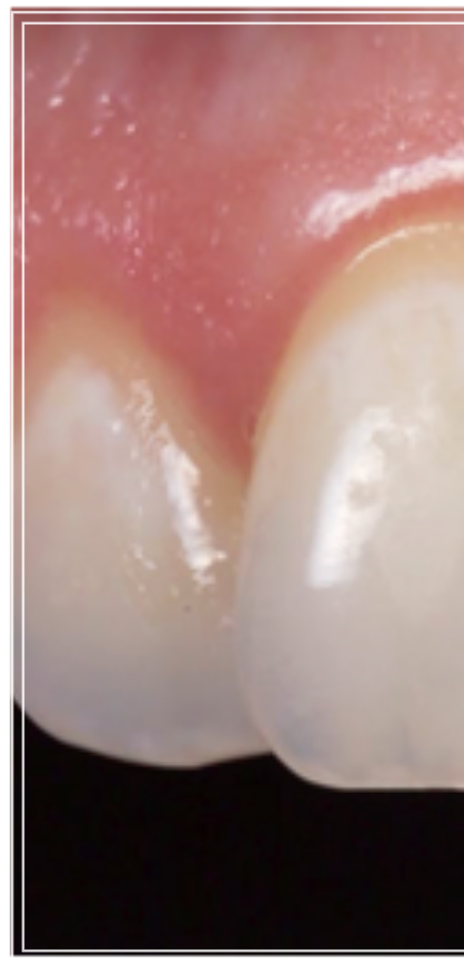 탕후루 치아 손상을 유발? 치료 방법 및 후기 관련 이미지 2