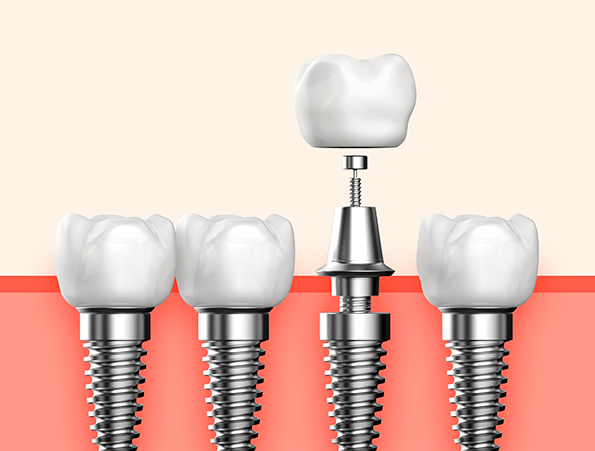 임플란트 부작용 총정리 [ 임플란트 전후 주의사항 ] [ 강남새로치과 ] 관련 이미지 4