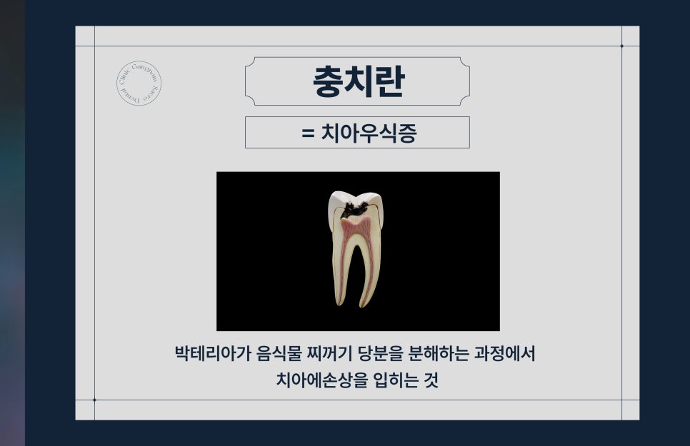 충치치료방법 레진, 인레이/온레이, 크라운 차이 (충치치료비용) 관련 이미지 2