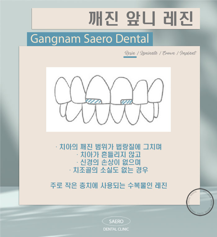 앞니가 깨졌어요! (깨진앞니 치료법) 관련 이미지 4