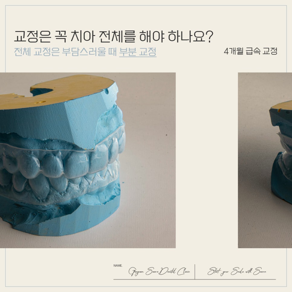 4개월만에 끝나는 부분교정 (급속교정후기) 관련 이미지 1