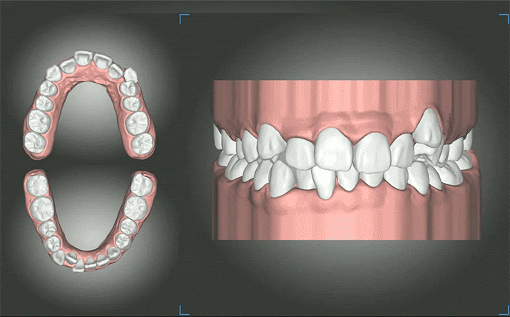 투명교정하기 전 알아두면 도움되는 정보 관련 이미지 8