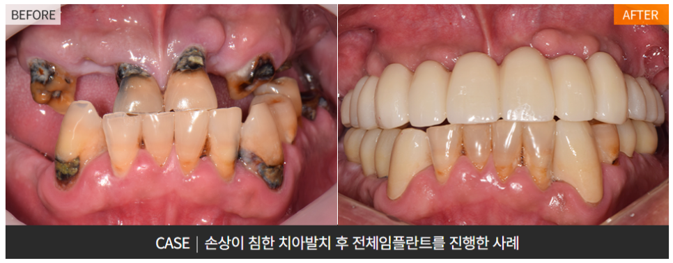 65세이상임플란트 (전체임플란트전후) 관련 이미지 4