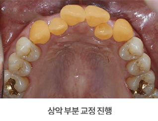 4개월 급속교정 (전체교정은 부담스럽다면 부분교정) [ 강남새로치과 ] 관련 이미지 5