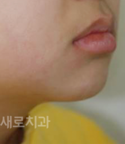 유아 주걱턱교정, 올바른 뼈 성장을 위한 방법 관련 이미지 3