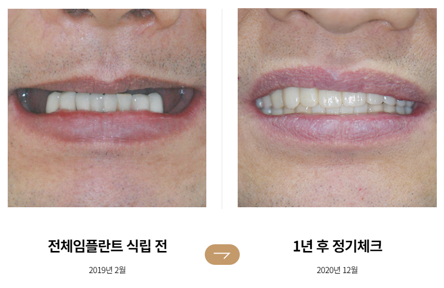 65세이상임플란트 (전체임플란트전후) 관련 이미지 3