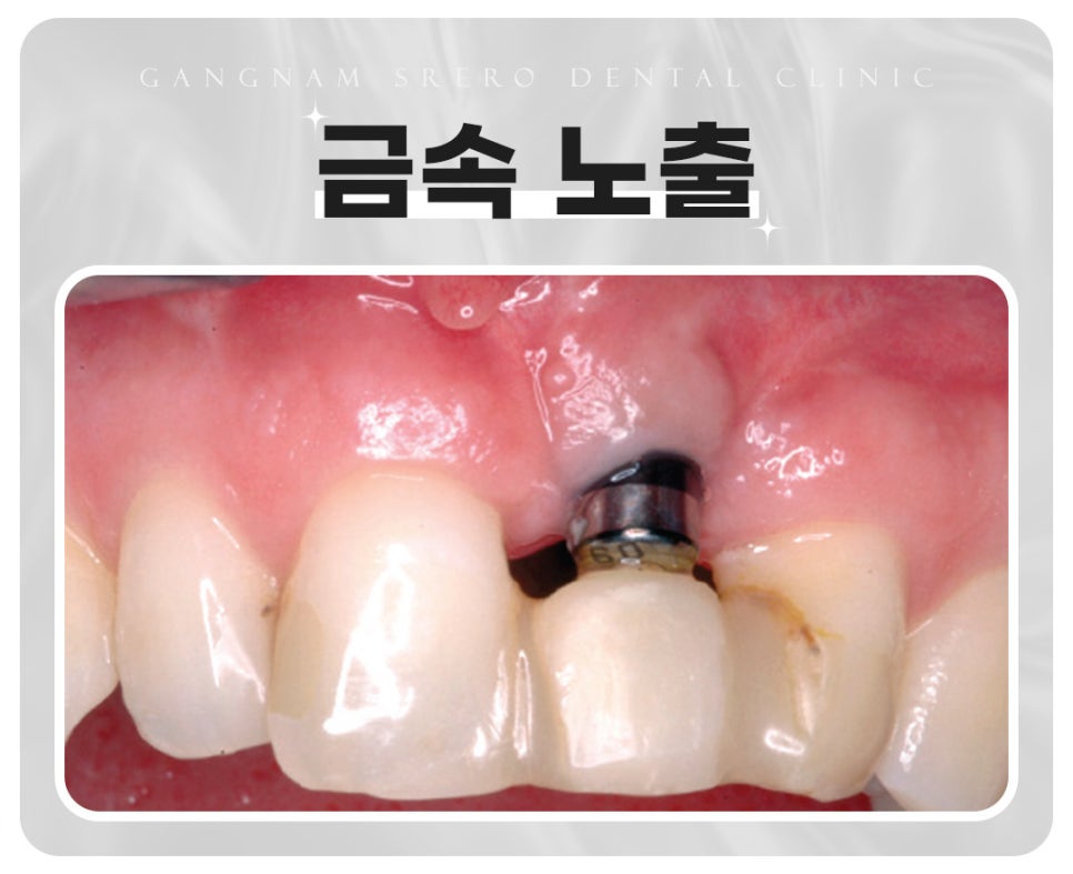 임플란트 부작용 자세히 알아보기(3) 임플란트 치주조직손상 부작용 [ 예방 및 대처 방법 ] [ 강남새로치과 ] 관련 이미지 4