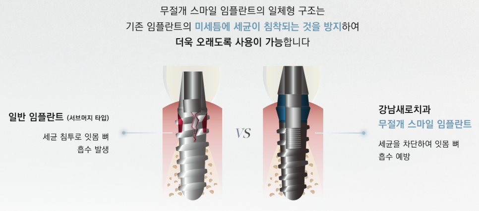 임플란트부작용 보철 (크라운, 지대주, 픽스쳐) 예방 및 대처 방법 관련 이미지 11