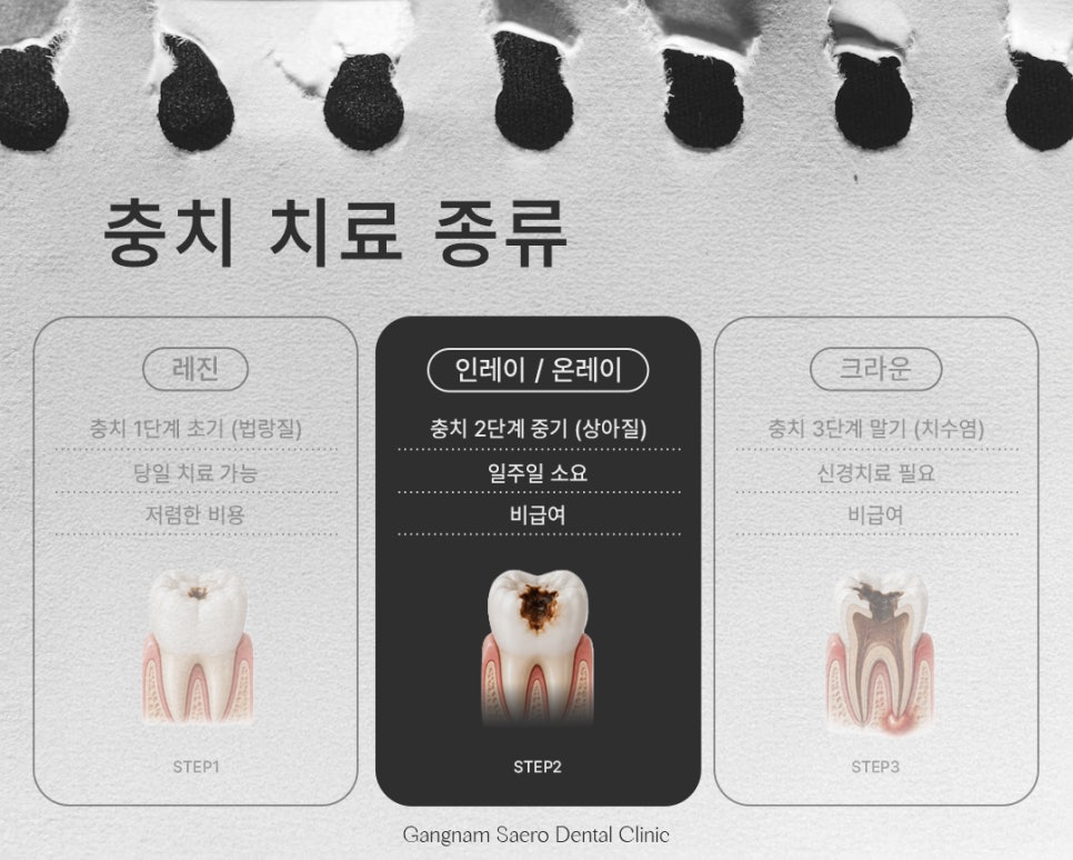 Types and Materials of Dental Caries Treatment by Stage (Types of Cavity Treatment) image 6