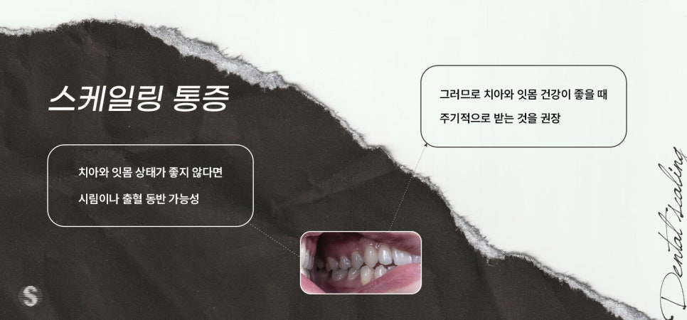 올해 지나기 전에 스케일링 건강보험적용, 놓치지 마세요! (스케일링통증 스케일링비용) 관련 이미지 3