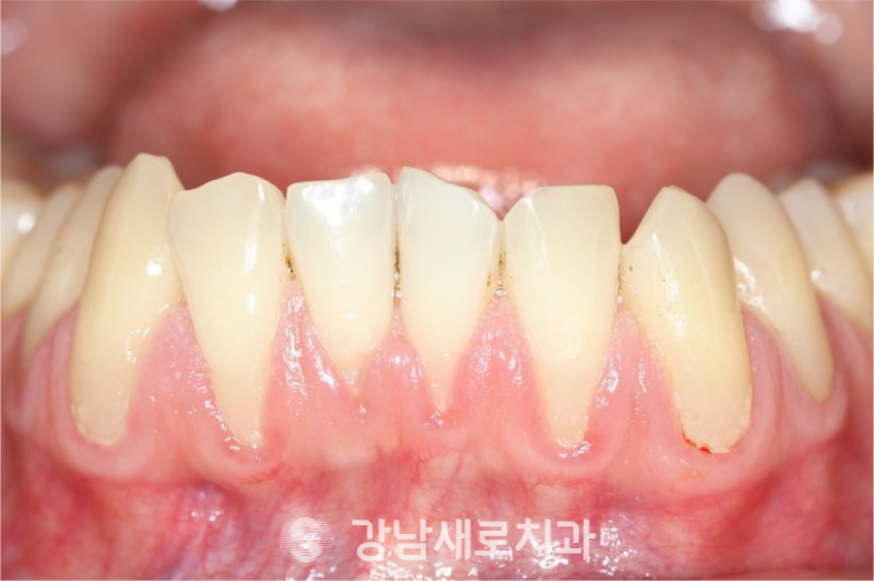 송곳니덧니교정, 방치하면 부작용이 발생한다? 관련 이미지 11