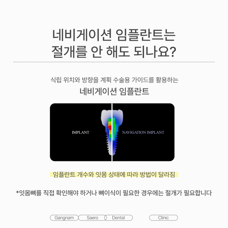 임플란트 많이 아플까요? 수술 전 알아둘 임플란트통증 및 진정치료 관련 이미지 5