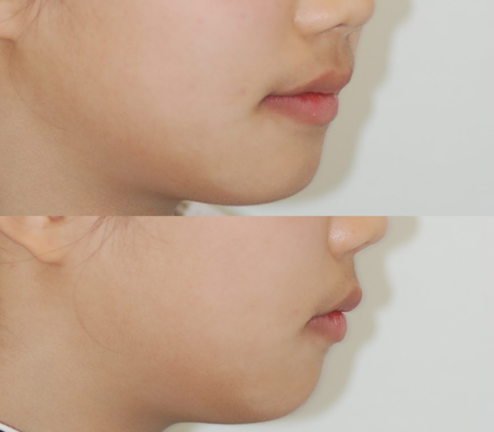 콤플렉스인 뻐드렁니 돌출입 교정으로 개선이 가능할까? 관련 이미지 7