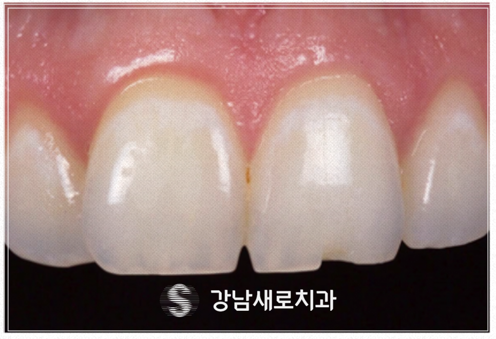 탕후루 치아 손상된 사례 진료 후기 관련 이미지 2