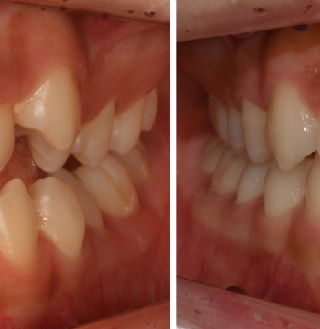 비발치교정 치료, 발치 없이 진행하는 과정 관련 이미지 9