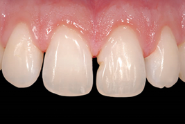 치아크랙 치아벌어짐 치아파절 회복하는 방법 (치아레진) 관련 이미지 4