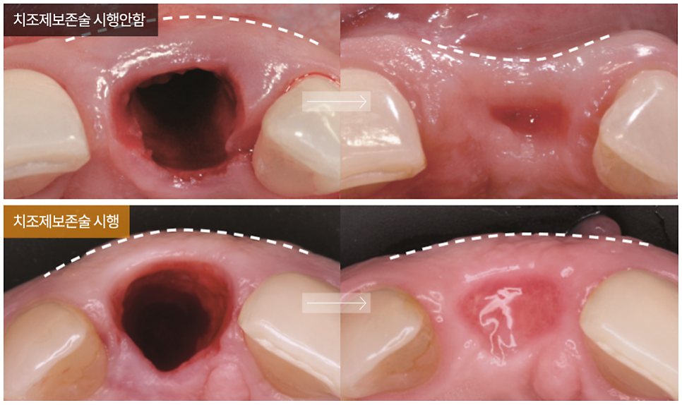 임플란트 수술 전 확인 사항 [ 병원 선택 기준 / 과잉진료 피하는 방법 ] [ 강남새로치과 ] 관련 이미지 2