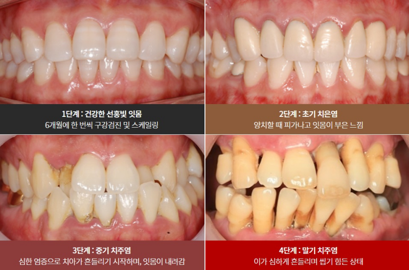 잇몸에서 피가 난다면, 관련 이미지 3