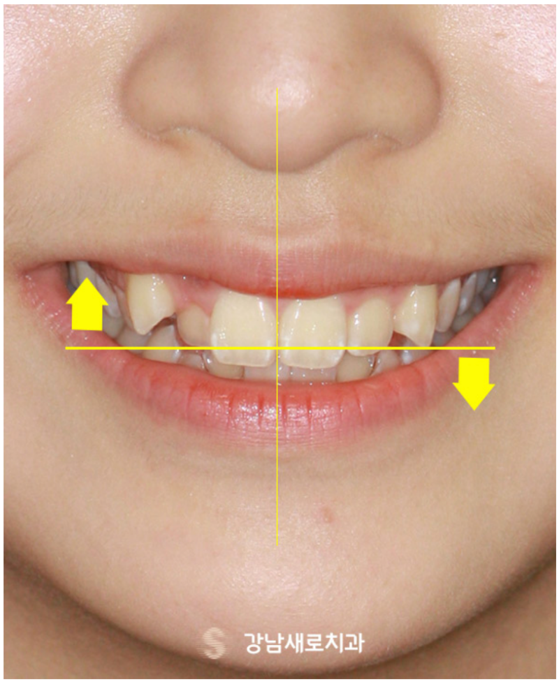 송곳니덧니교정을 발치 문제 없이 진행할 수 있다면? 관련 이미지 9