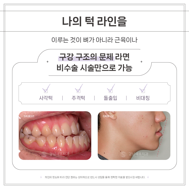 교정 얼굴형 변화 (양악교정 비수술양악) 관련 이미지 2