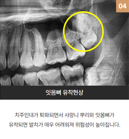 강남역근처치과 사랑니부작용 (사랑니발치) 관련 이미지 6