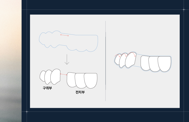 양심치과가 말해주는 투명교정 한계점 [ 강남새로치과 ] 관련 이미지 3