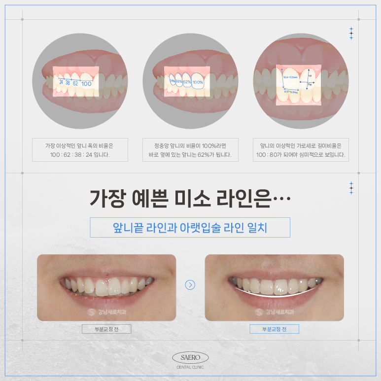 LPA MTA 부분교정 (앞니만 교정하고 싶을 땐 전체교정 대신 부분교정) [ 강남새로치과 ] 관련 이미지 11