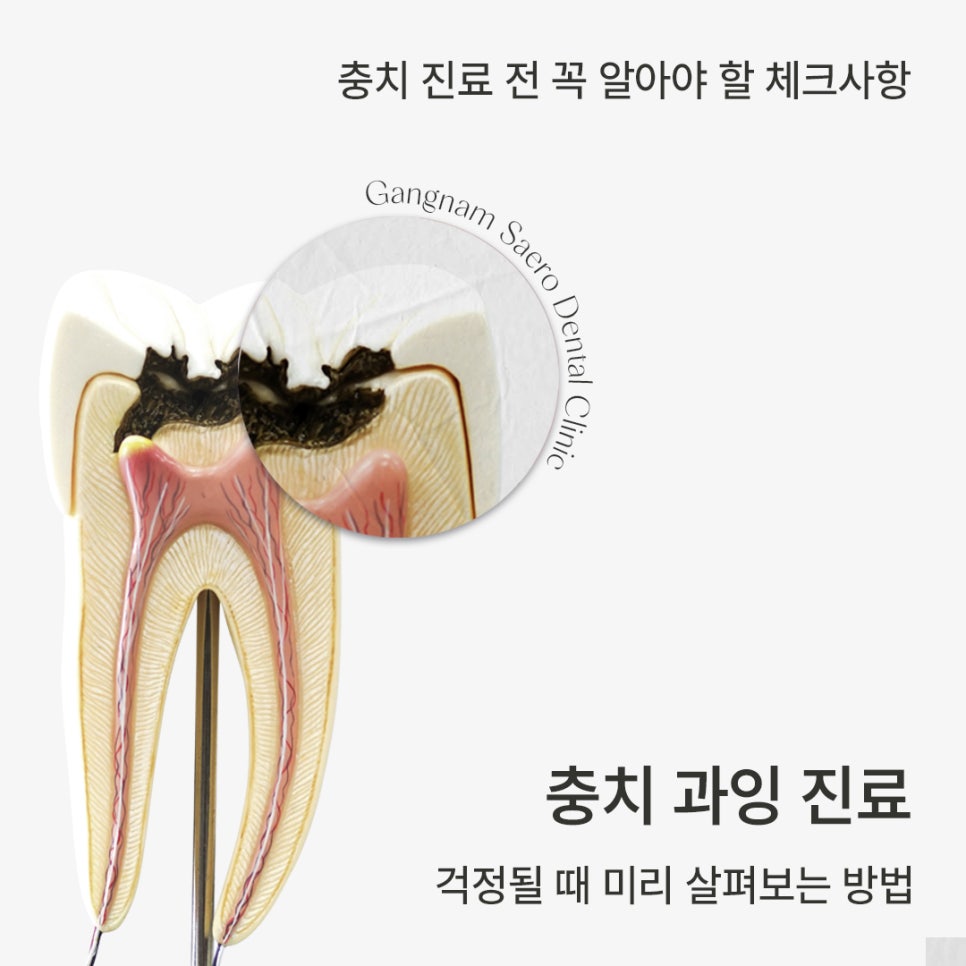 Essential Checks to Know Before Cavity Treatment (Overtreatment of Cavities) image 1
