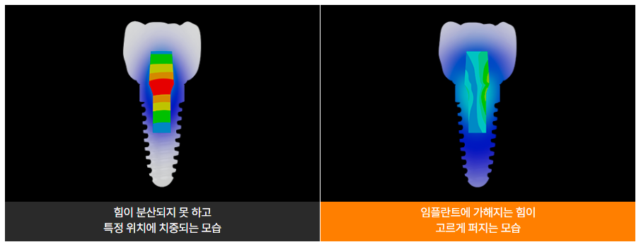 임플란트 영구적이 아닌가요? (임플란트수명) 관련 이미지 8