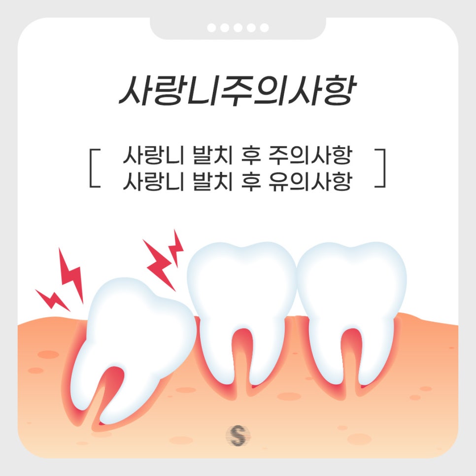 사랑니발치 후 주의사항 및 유의사항 (사랑니발치치과) 관련 이미지 1