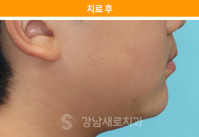 유아 주걱턱교정, 올바른 뼈 성장을 위한 방법 관련 이미지 5