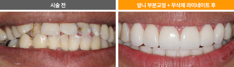 누런 앞니, 치아의 문제를 에어네이트 진료로 해결하려면 관련 이미지 6