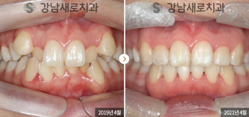 송곳니덧니교정, 방치하면 부작용이 발생한다? 관련 이미지 5