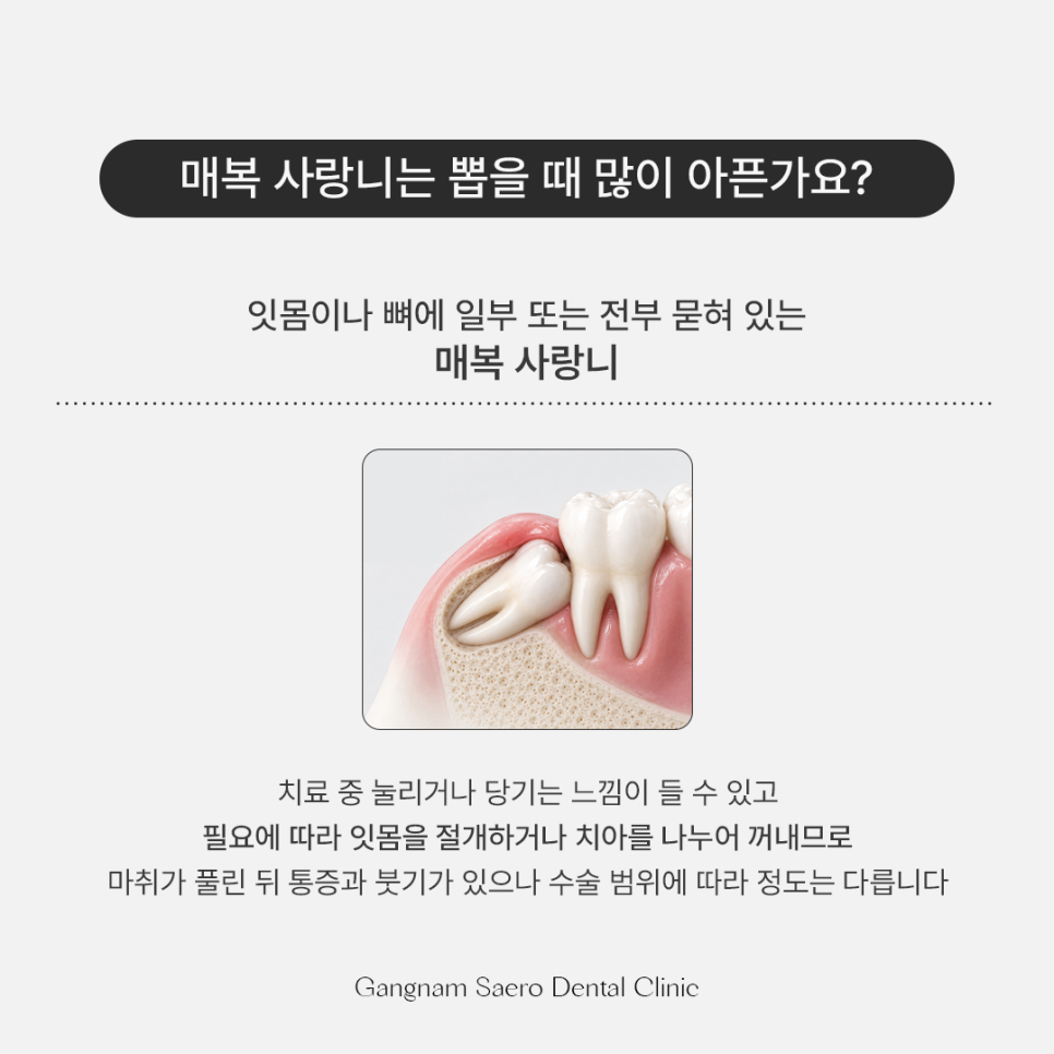 사랑니발치, 꼭 뽑아야 하나요? 통증 식사 흡연 안내 관련 이미지 4