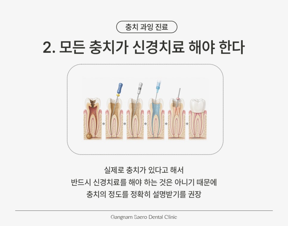 Essential Checks to Know Before Cavity Treatment (Overtreatment of Cavities) image 3