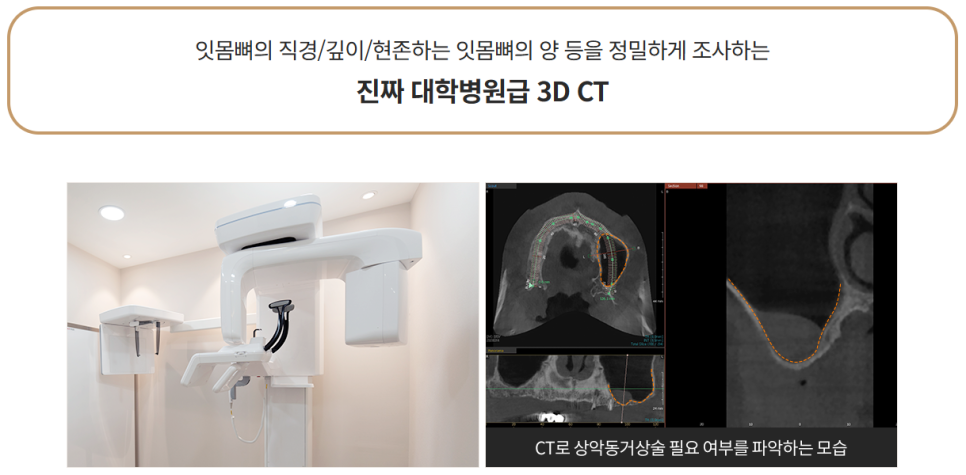 윗니 임플란트 부작용 최소화하려면 (상악동거상술) 관련 이미지 4