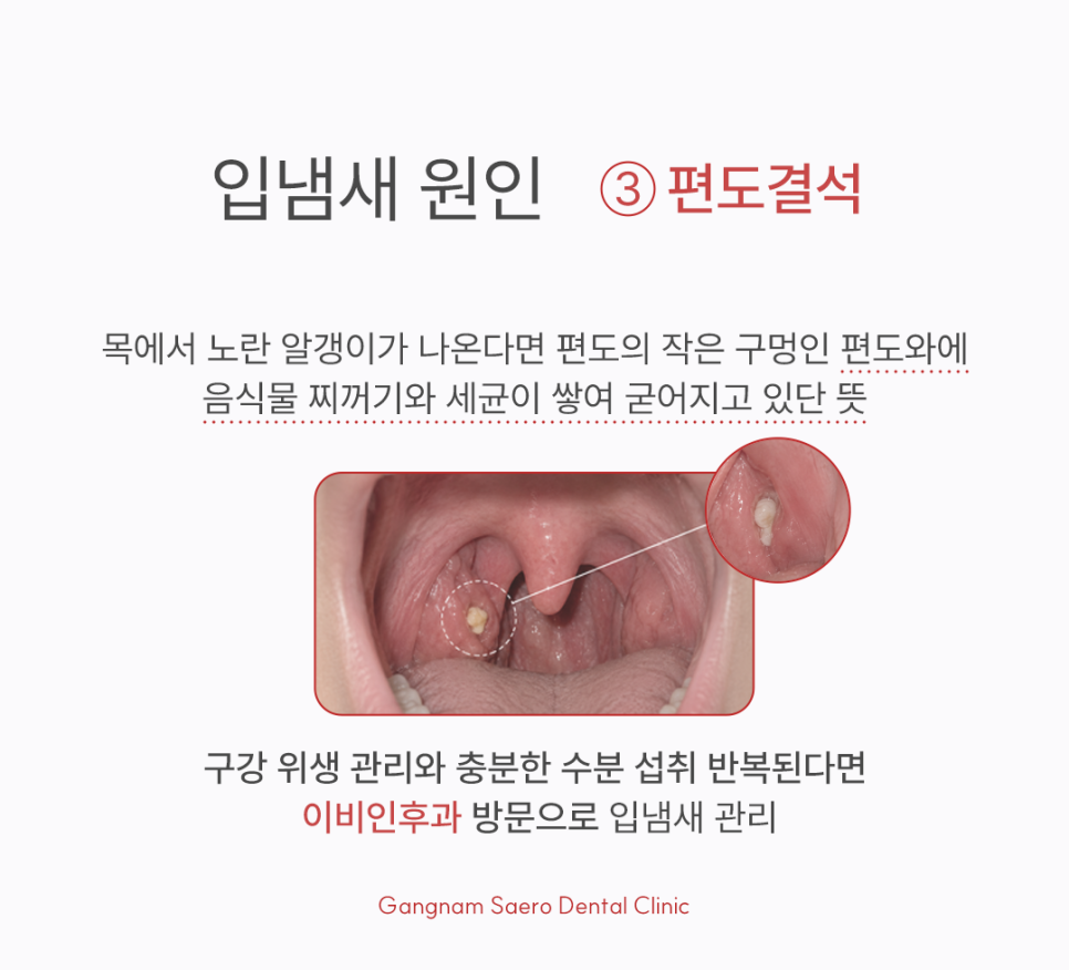 Bad Breath Clinic: What If You Have Bad Breath Even Though You Brush Regularly? image 5