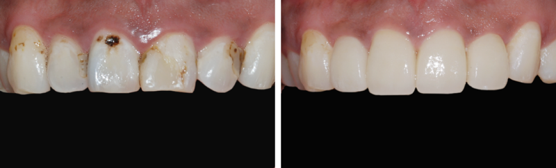 누런 앞니, 치아의 문제를 에어네이트 진료로 해결하려면 관련 이미지 9