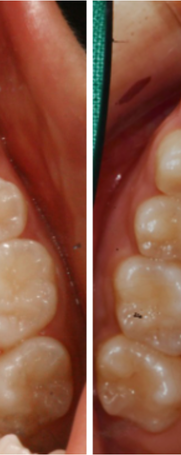 비발치교정 치료, 발치 없이 진행하는 과정 관련 이미지 6