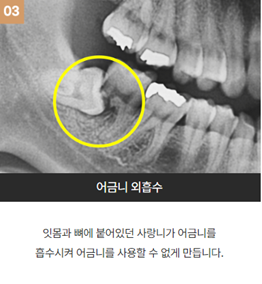 강남역근처치과 사랑니부작용 (사랑니발치) 관련 이미지 5