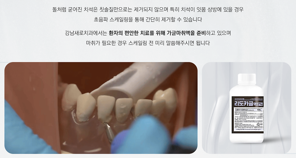 치과공포증 있어도 스케일링 편안하게 (무통스케일링) 관련 이미지 3