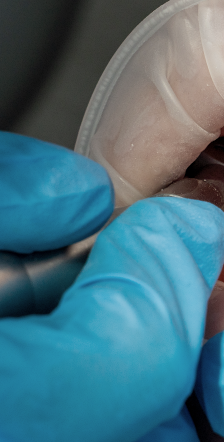 치은염 증상 어떠한 문제들이 있을까요? 관련 이미지 5