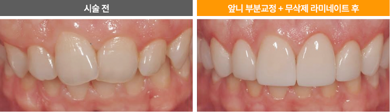 누런 앞니, 치아의 문제를 에어네이트 진료로 해결하려면 관련 이미지 5