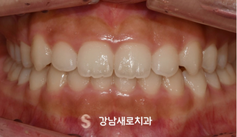 송곳니 덧니 교정없이 방치하면 발생하는 문제? 관련 이미지 5