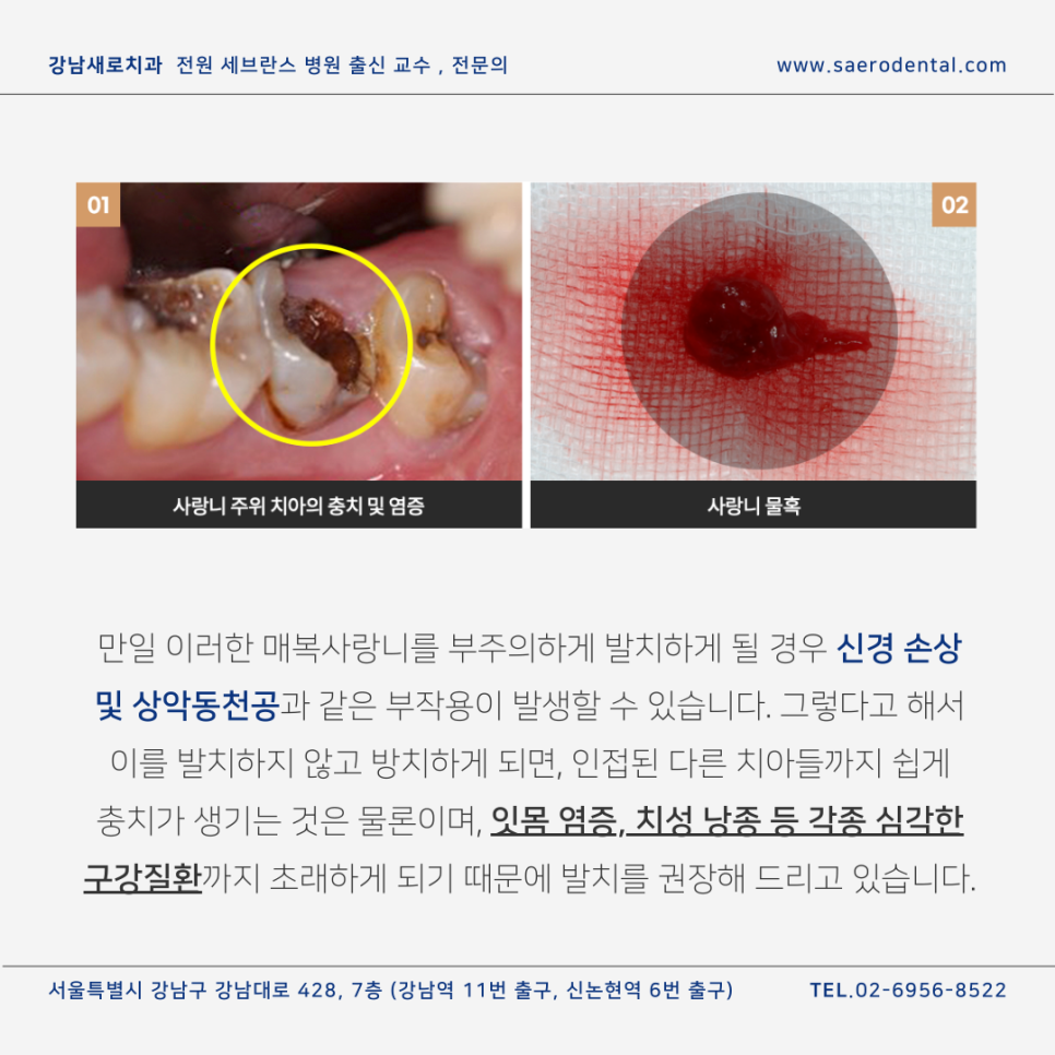강남사랑니치과, 매복사랑니를 더욱 효율적으로 발치하려면 관련 이미지 7