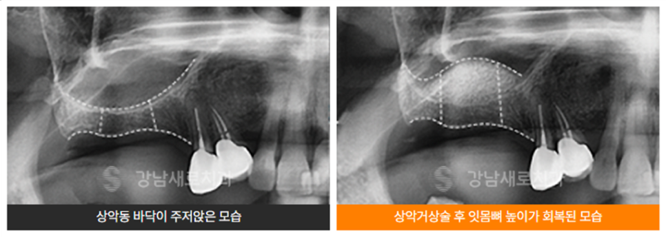 윗니 임플란트 안정성 높이는 강남새로치과 핵심 술식 （상악동거상술） 관련 이미지 5