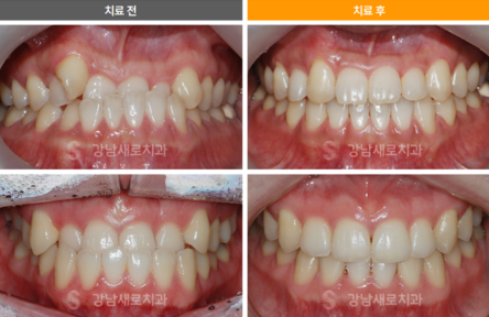 비수술 주걱턱 교정 (양악수술 대신 교정이 가능할까요?) [ 강남새로치과 ] 관련 이미지 8